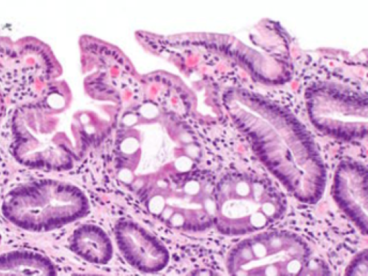 Intestinal metaplasia of the stomach in a candidate for bariatric surgery