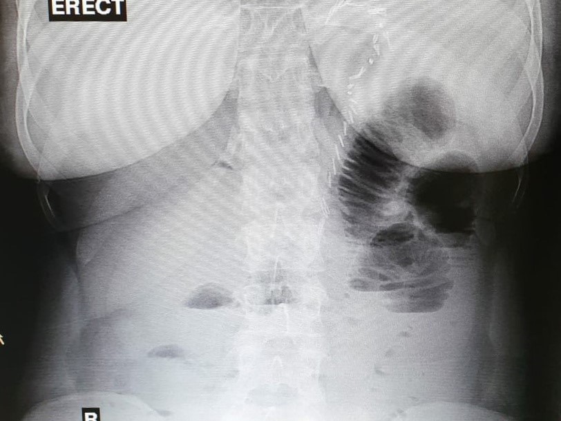 Internal hernia after single anastomosis sleeve ilial bypass (SASI)