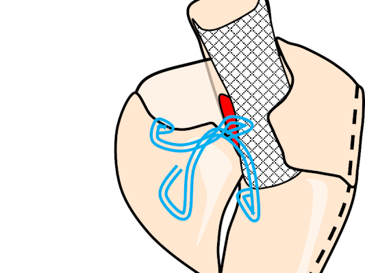 BARIAlink - Laparoscopic Roux-en-Y-fistulo-jejunostomy as a salvage ...